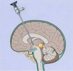 Endoscopia cerebral