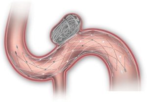 Neuroform