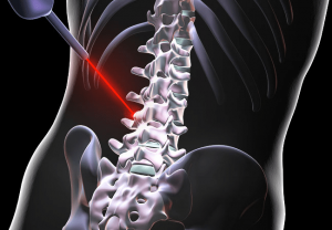 Qual-o-preco-de-uma-cirurgia-de-coluna-300x208