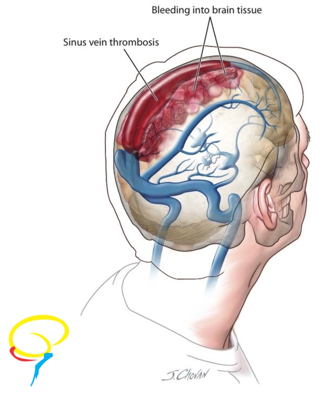 Венозный застой крови. Венозная дисциркуляция головного мозга что это такое. Венозный отток головного мозга. Нарушение венозного оттока головного.
