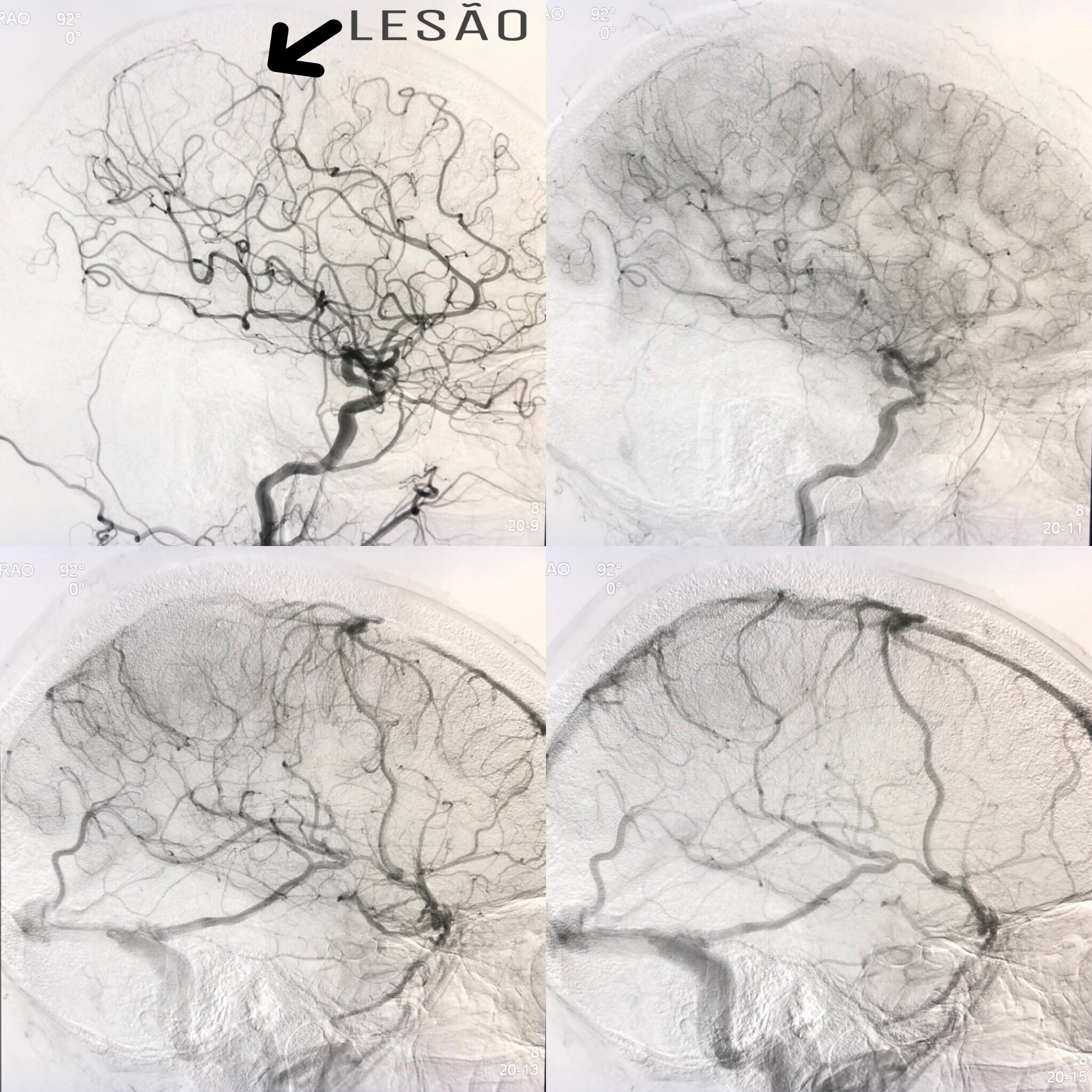 Figura 4: Arteriografia cerebral pré operatória.