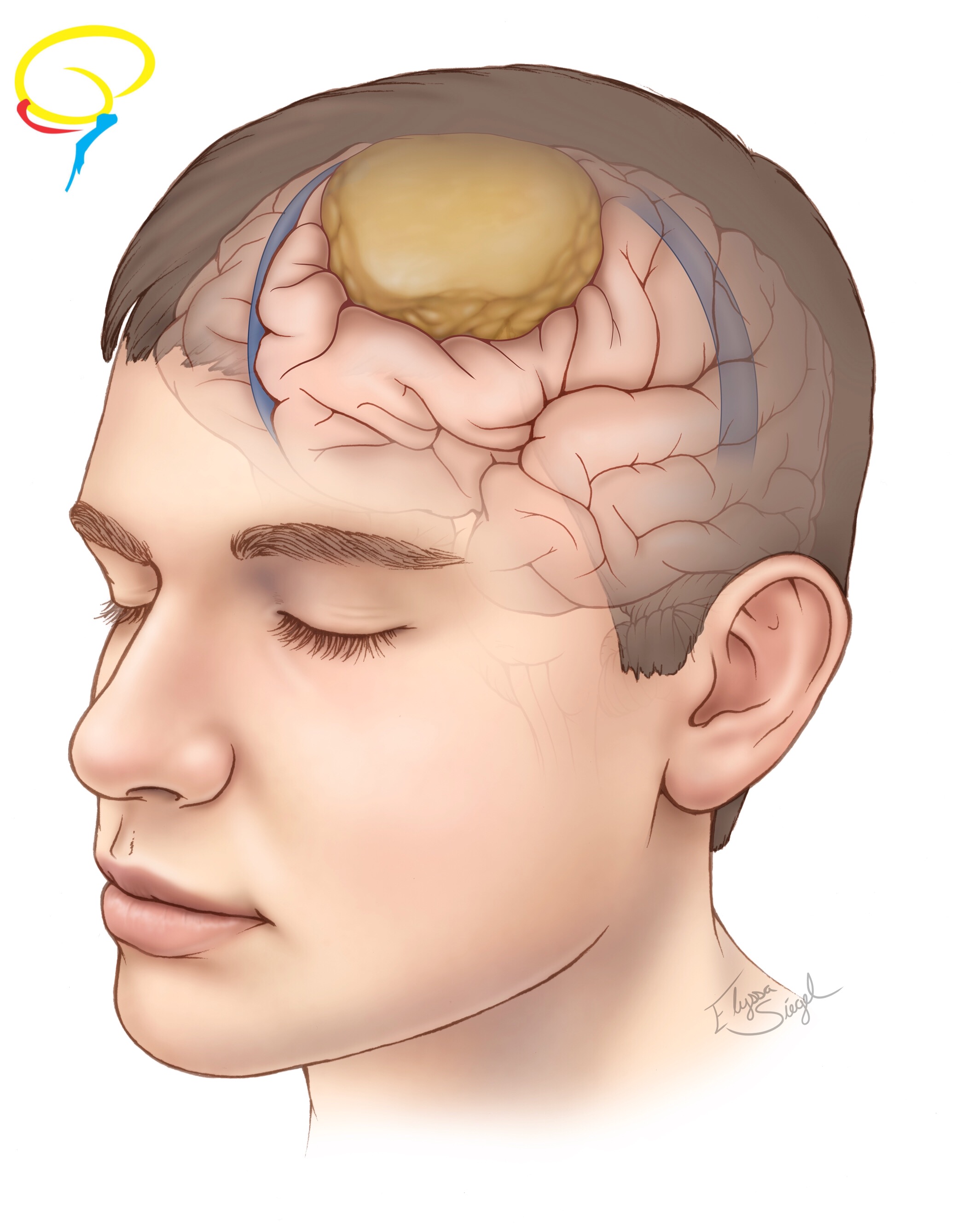 Figura 1: Desenho esquemático demonstrando um meningioma de convexidade.