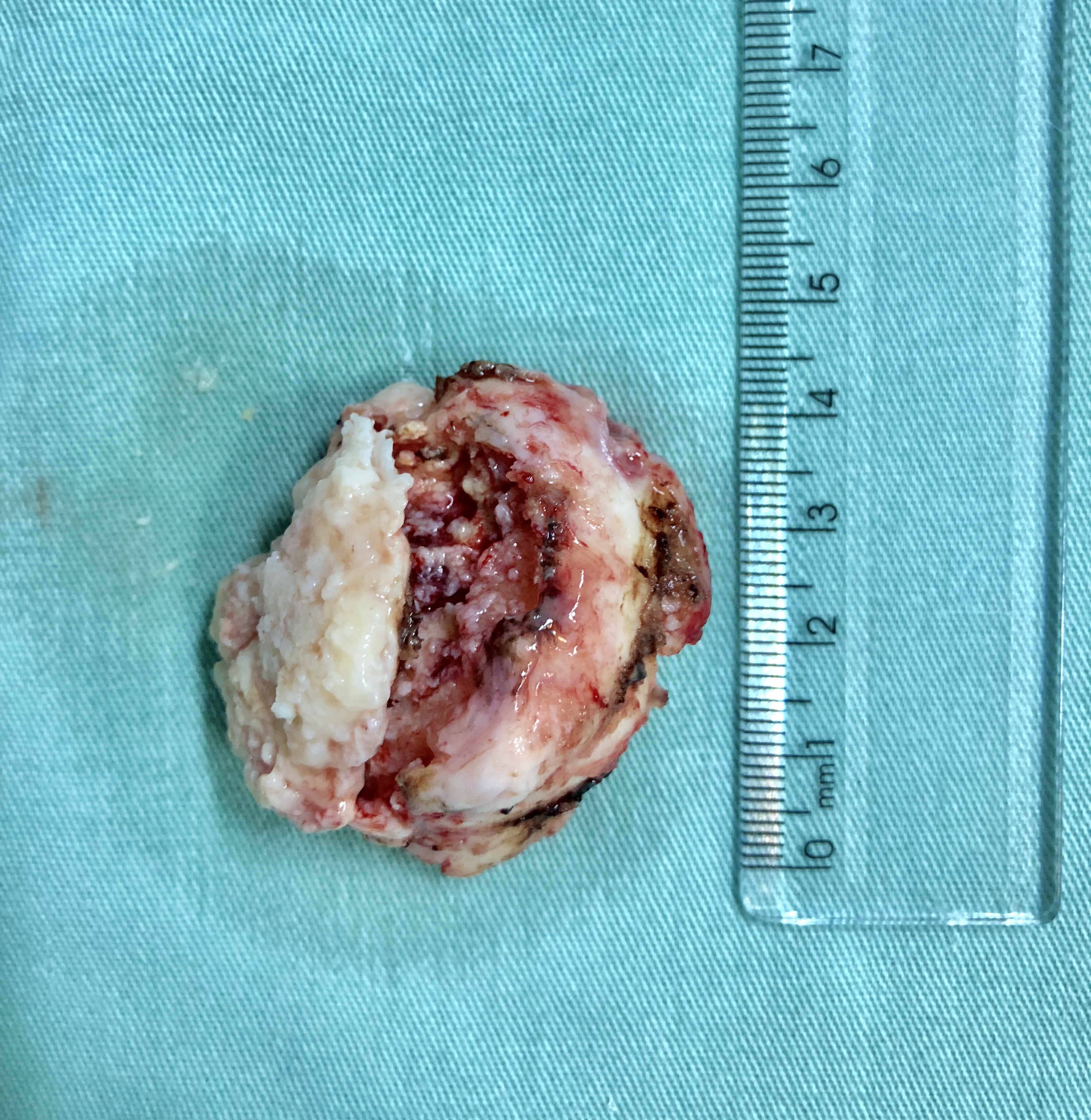 Figura 8: Aspecto da peça cirúrgica removida. As dimensões são compatíveis com os achados da ressonância pré-operatória. Diagnóstico anatomopatológico: Meningioma Meningotelial - Grau I OMS.