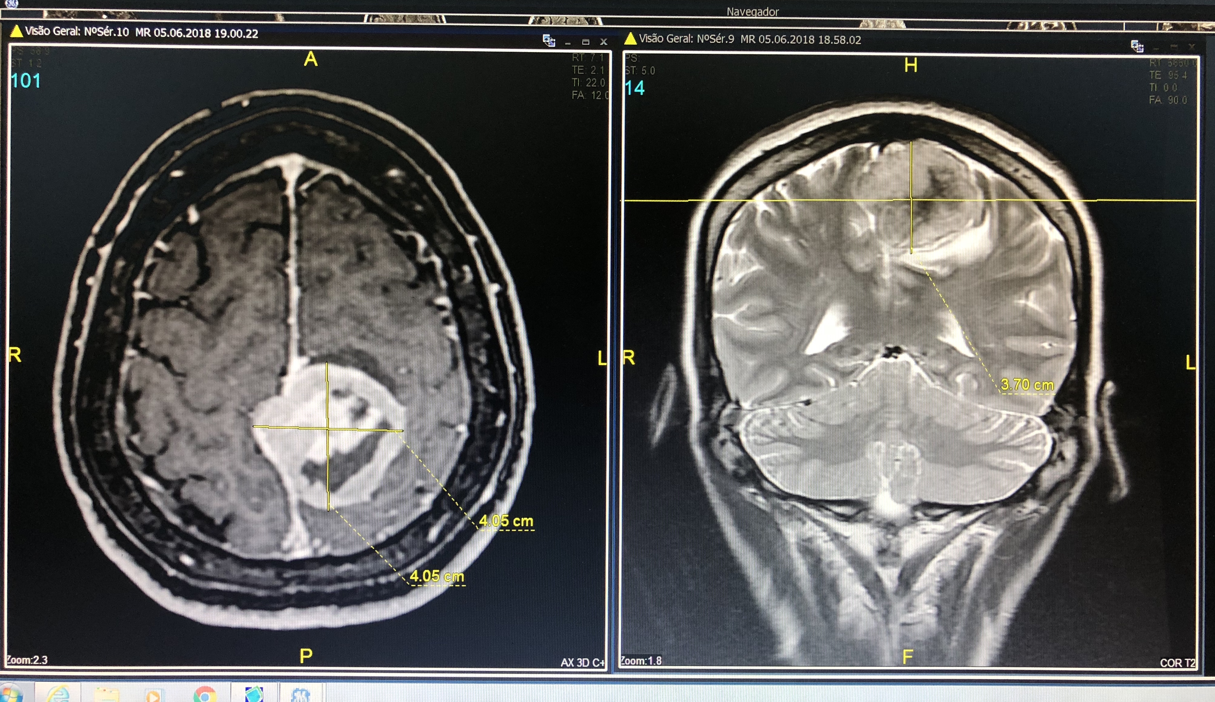 Figura 3: Ressonância cerebral pré-operatória de um caso operado pela equipe da Neurochirurgie. 
Meningioma parafalcino com invasão do terço posterior do seio sagital superior - SSS (Sindou IV).